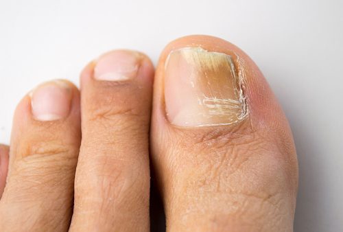 Brittle Toenails Causes And Home Remedies