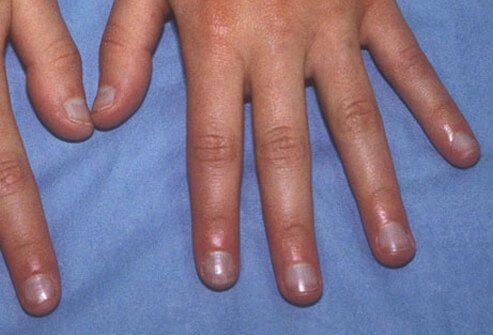 Are Blue Fingernails A Sign Of Dehydration
