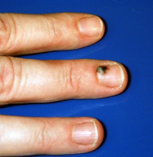 Subungual Hematoma Black Bruised Fingernail Drainage Treatment